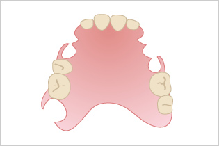 入れ歯の種類のイメージ０３