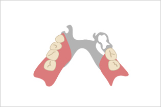 入れ歯の種類のイメージ０４
