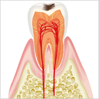 虫歯の初期=「C1」のイメージ