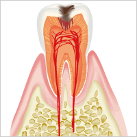 虫歯の中期=「C2」のイメージ