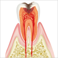 虫歯の末期=「C4」のイメージ